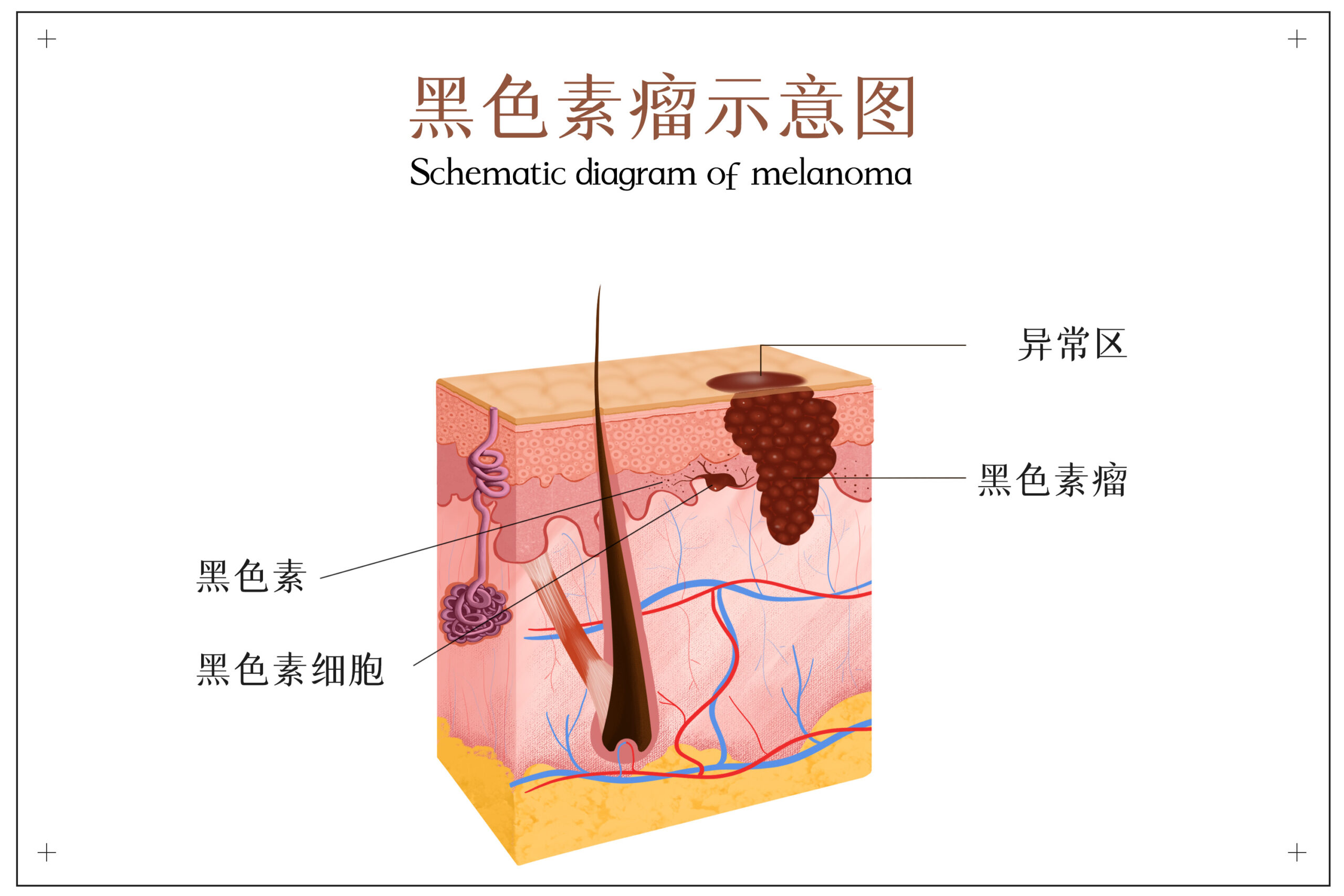 身上長這種痣，當心是瘤！哪些保險能賠？插圖1